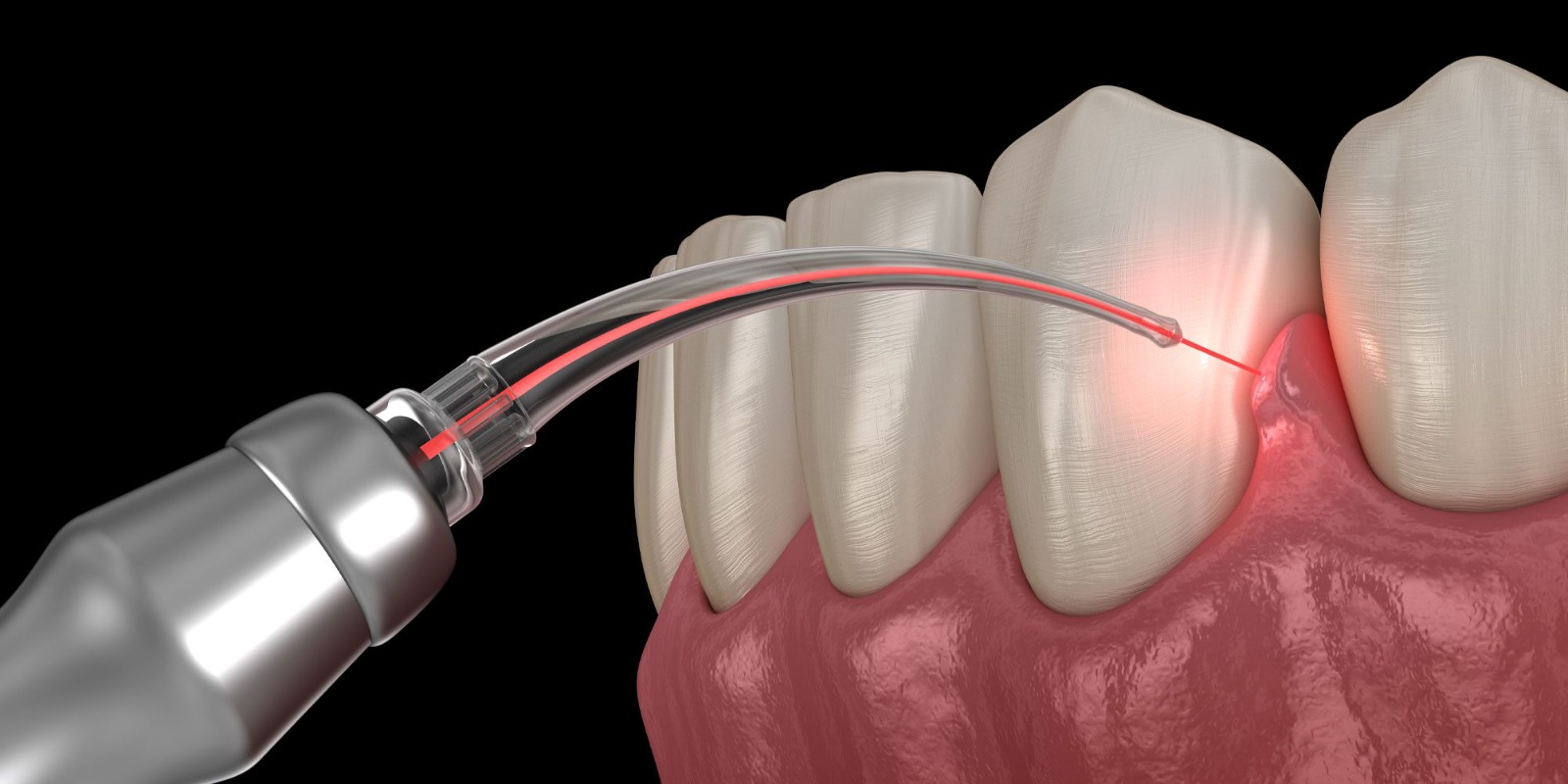 How To Prevent Abscess Formation in The Mouth? A Detailed Guide