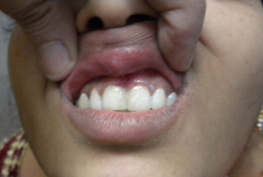 7. diastema closed close up view