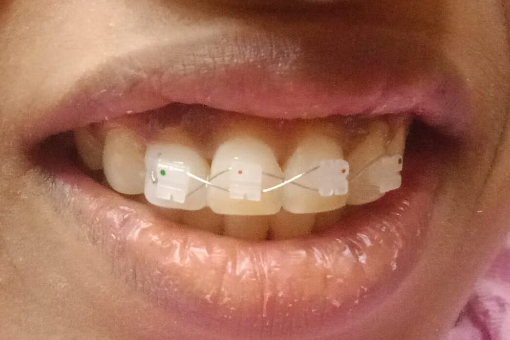 CERAMIC BRACES