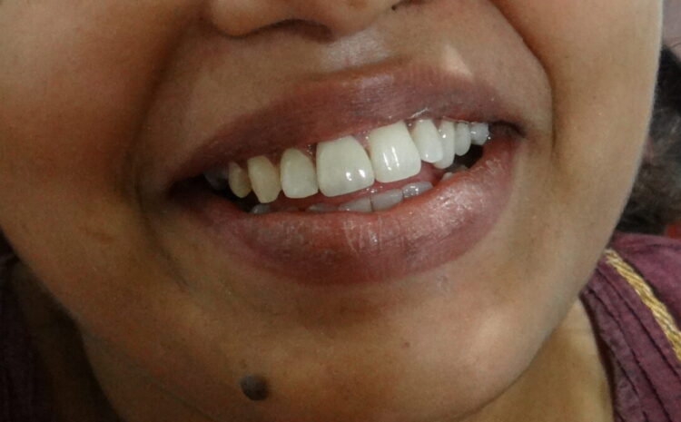 6 Compelling Reasons Why You Should Consider Teeth Whitening 