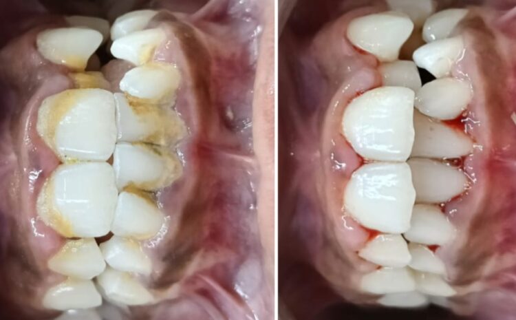 Scaling and Bleaching – The secret to Healthy and Confident Smile.