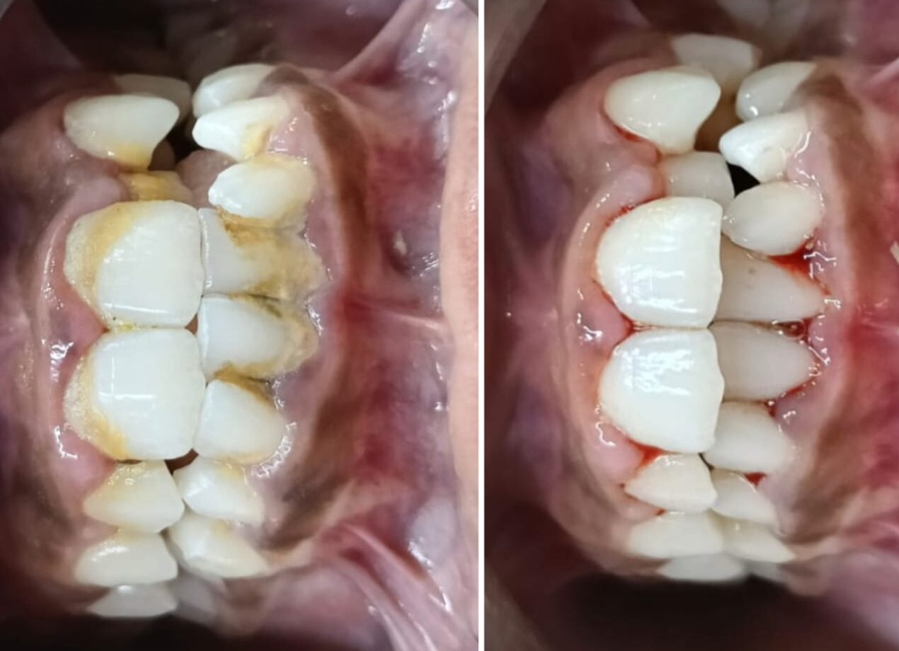 Scaling and Bleaching – The secret to Healthy and Confident Smile.